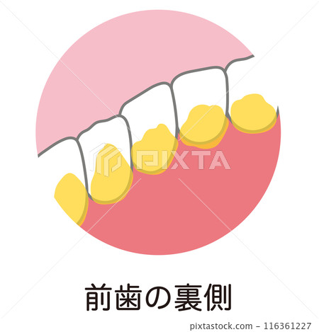 前牙背積聚的牙菌斑，是刷牙時殘留的 116361227