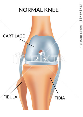 Knee arthrosis. Healthy knee structure. Bone exposure, healthy knee structure comparison. Medical poster with foot bones. Isolated vector illustration Knee arthrosis. Healthy knee structure. Bone exposure, healthy knee structure comparison. Medical poster with foot bones. Isolated vector illustration 116361738