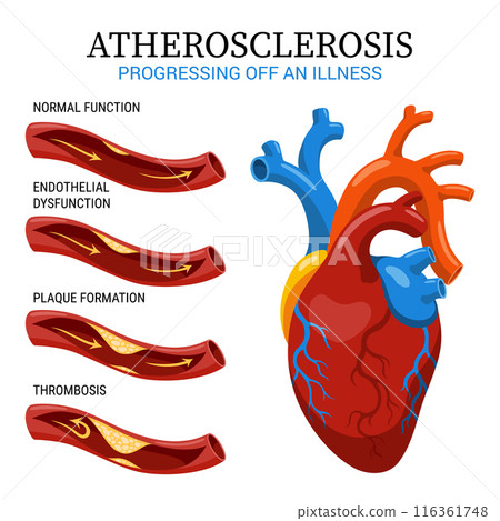 Atherosclerosis stages. Anatomy of heart attack. Arteriosclerotic vascular disease or ASVD. Atherosclerotic plaque in coronary artery. Vector illustration on white background 116361748