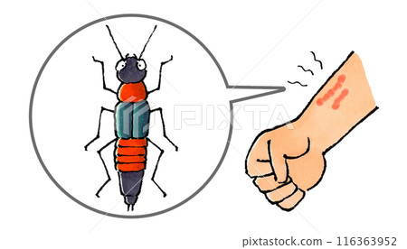Arm inflamed by the fluids of a burn bug Arm inflamed by the fluids of a burn bug 116363952