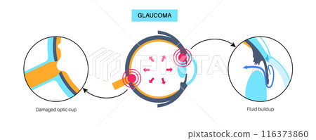 Glaucoma eye disease 116373860