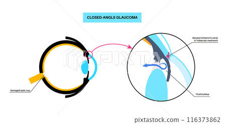 Glaucoma eye disease 116373862