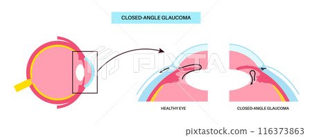 Glaucoma eye disease Glaucoma eye disease 116373863