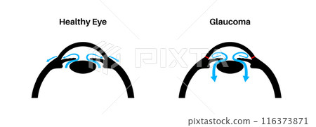 Glaucoma eye pressure 116373871