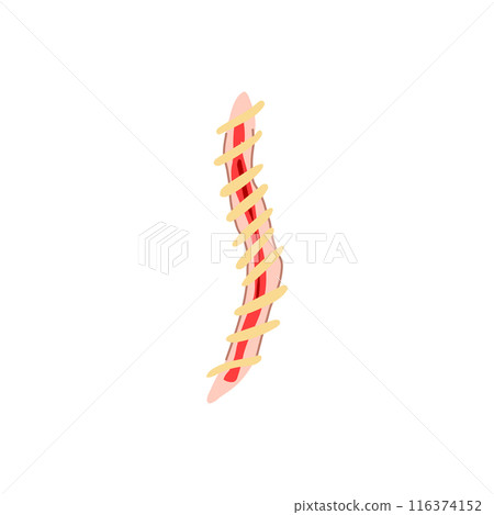 surgical suture cartoon vector illustration 116374152