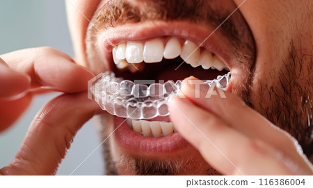 A young man inserting clear orthodontic aligners into his mouth. Transparent aligners for straightening teeth, dental aesthetics, care and maintenance of teeth 116386004