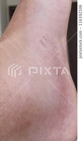 Snake bite Snake bite 116392506