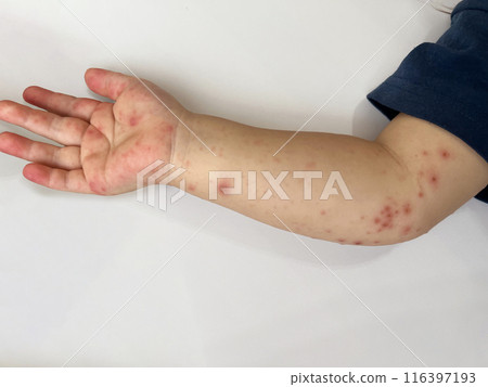 嬰兒手臂因手足口病出現皮疹 嬰兒手臂因手足口病出現皮疹 116397193