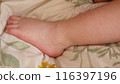 手足口病引起的嬰兒腳部出現皮疹 116397196