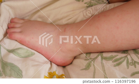 手足口病引起的嬰兒腳部出現皮疹 手足口病引起的嬰兒腳部出現皮疹 116397196