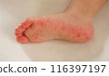 因手足口病而出現皮疹的幼兒腳底 116397197