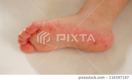 The soles of a child's feet with a rash caused by hand, foot and mouth disease The soles of a child's feet with a rash caused by hand, foot and mouth disease 116397197