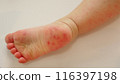 因手足口病而出現皮疹的幼兒腳底 116397198