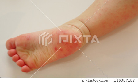 The soles of a child's feet with a rash caused by hand, foot and mouth disease The soles of a child's feet with a rash caused by hand, foot and mouth disease 116397198
