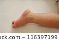 手足口病引起的嬰兒腳部出現皮疹 116397199