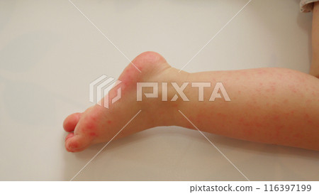 手足口病引起的嬰兒腳部出現皮疹 手足口病引起的嬰兒腳部出現皮疹 116397199