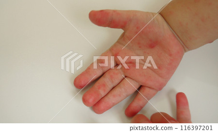 Palms of a toddler with a rash caused by hand, foot and mouth disease 116397201