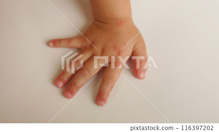 A child's hand with a rash caused by hand, foot and mouth disease 116397202