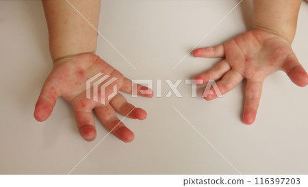 Both hands of a toddler with a rash caused by hand, foot and mouth disease Both hands of a toddler with a rash caused by hand, foot and mouth disease 116397203