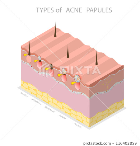 3D Isometric Flat Illustration of Types Of Acne Papules, Skin Problems 3D Isometric Flat Illustration of Types Of Acne Papules, Skin Problems 116402859