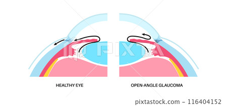 Glaucoma eye disease 116404152