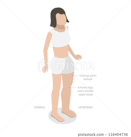 3D Isometric Flat Illustration of Lipoedema, Overweight Issues 3D Isometric Flat Illustration of Lipoedema, Overweight Issues 116404736