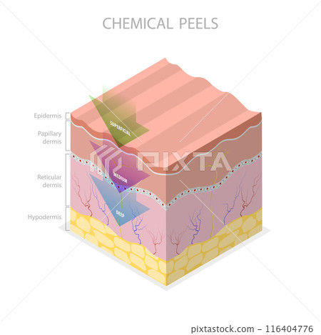 3D Isometric Flat Illustration of Skin Chemical Peel, Beauty Aesthetic Treatment 3D Isometric Flat Illustration of Skin Chemical Peel, Beauty Aesthetic Treatment 116404776