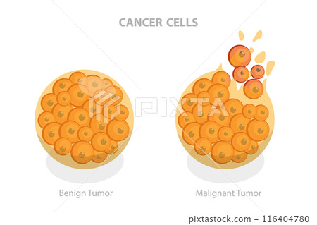 3D Isometric Flat  Illustration of Cancer Cells, Tumor Development 116404780