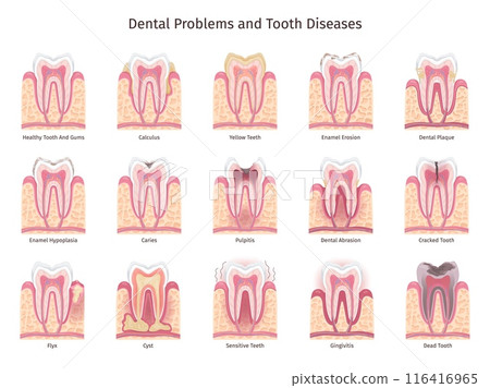 Teeth problems infographic. Human tooth decay, oral cavity problem dentist brochure sensitive teeths care bleed gum caries pulpitis enamel root treatment swanky illustration 116416965