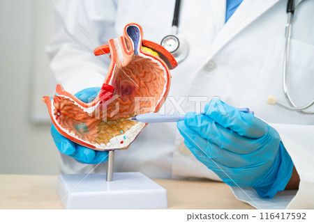Dyspepsia or gastric disease, doctor holding stomach anatomy model for study diagnosis and treatment in hospital. Dyspepsia or gastric disease, doctor holding stomach anatomy model for study diagnosis and treatment in hospital. 116417592