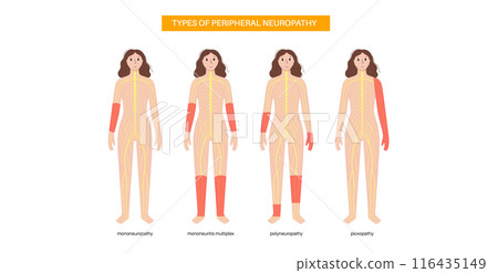 Peripheral neuropathy medical poster 116435149