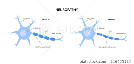 Peripheral neuropathy medical poster Peripheral neuropathy medical poster 116435153