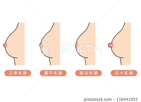 Nipple shape, nipple type, variety 116441955