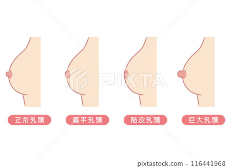 乳頭形狀 乳頭類型 類型 116441968
