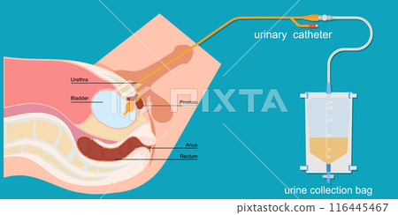 Urinary catheter in the male body with urinary bag. Urinary catheter in the male body with urinary bag. 116445467