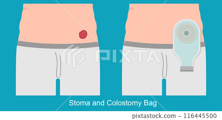 A colostomy is a surgical procedure that changes the trajectory of food waste. 116445500