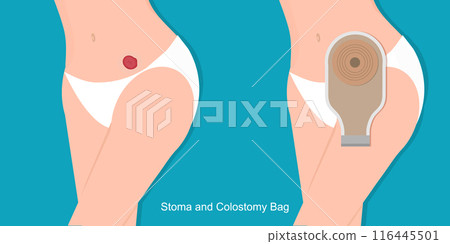 A colostomy in female is a surgical procedure. 116445501