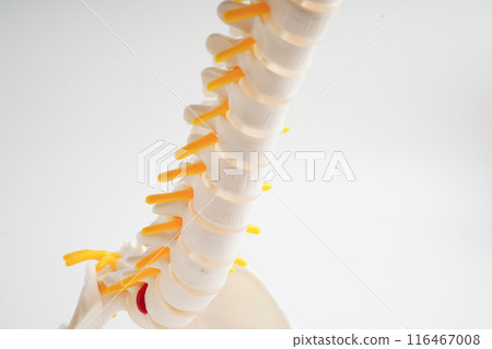 Spinal nerve and bone, Lumbar spine displaced herniated disc fragment, Model for treatment medical in the orthopedic department. 116467008