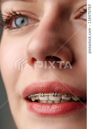 Young woman with dental braces close up Young woman with dental braces close up 116470763