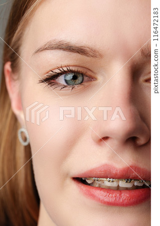 Young woman with dental braces close up Young woman with dental braces close up 116472183