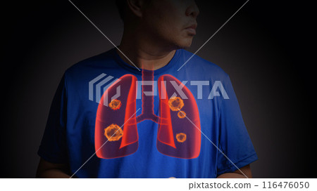 Lung cancer. 3d x-ray concept 116476050