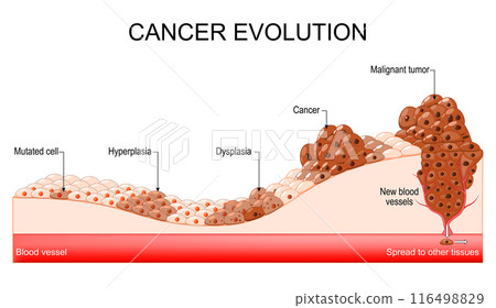 Cancer evolution. Mutated cell, Hyperplasia, Dysplasia, Malignant tumor. Cancer evolution. Mutated cell, Hyperplasia, Dysplasia, Malignant tumor. 116498829