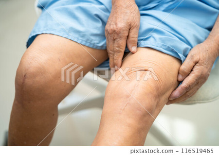 Asian elderly woman patient show her scars surgical total knee joint replacement Suture wound surgery arthroplasty. Asian elderly woman patient show her scars surgical total knee joint replacement Suture wound surgery arthroplasty. 116519465