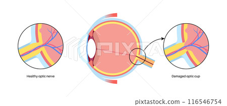 Damaged optic cup 116546754