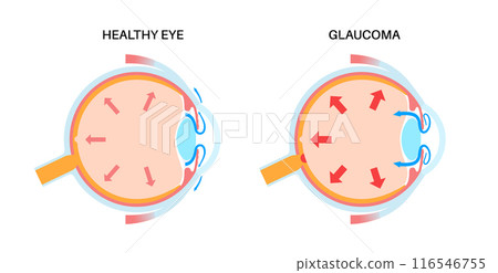 Glaucoma eye pressure Glaucoma eye pressure 116546755