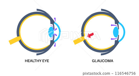 Glaucoma eye pressure 116546756