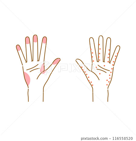 Illustration of common areas for hand eczema and sweat rash (female hands) 116558520