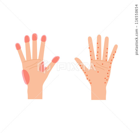 Illustration of common areas for hand eczema and sweat rash (female hands) 116558654