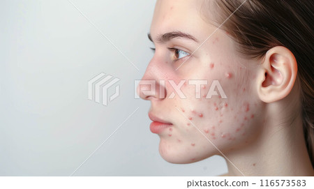 Acne pimple and scar on skin face, disorders of sebaceous glands, teenage girl skincare beauty problem. 116573583