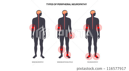 Peripheral neuropathy medical poster 116577917